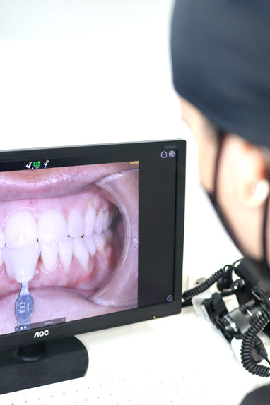 estetica dental en oviedo realizando un estudio de carillas dentales