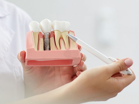 Síntomas y causas de rechazo de un implante dental