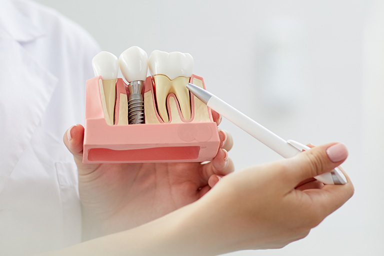 Síntomas y causas de rechazo de un implante dental