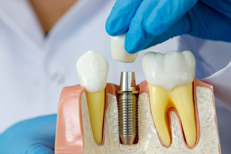 ¿En qué consiste la osteointegración de un implante dental?