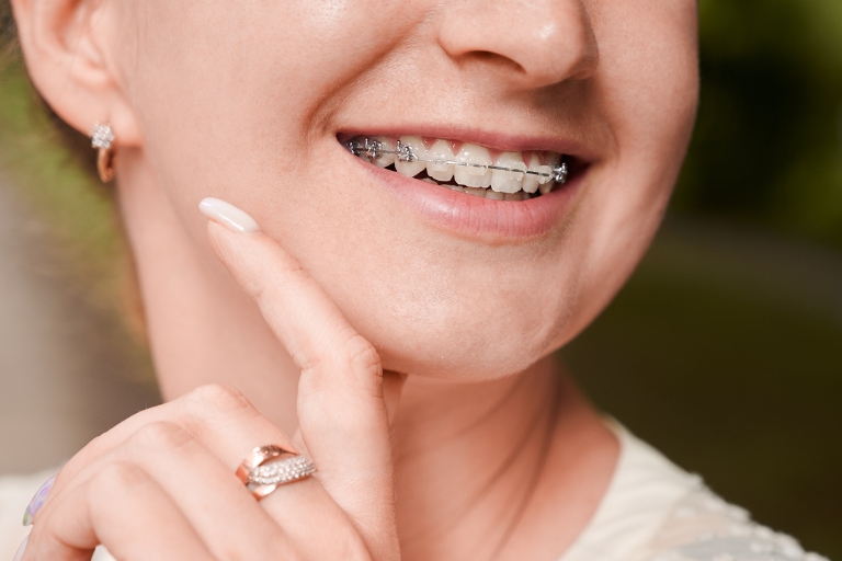 8 preguntas clave sobre la Ortodoncia