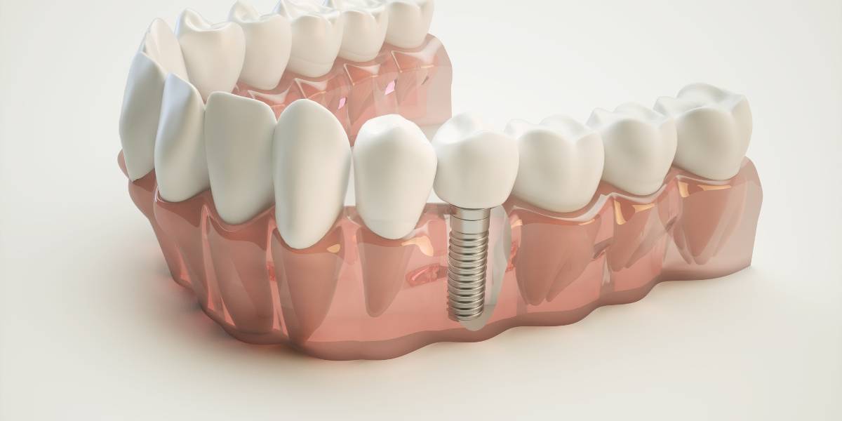los tratamientos combinados de ortodoncia e implantología requieren una buena coordinación multidisciplinar