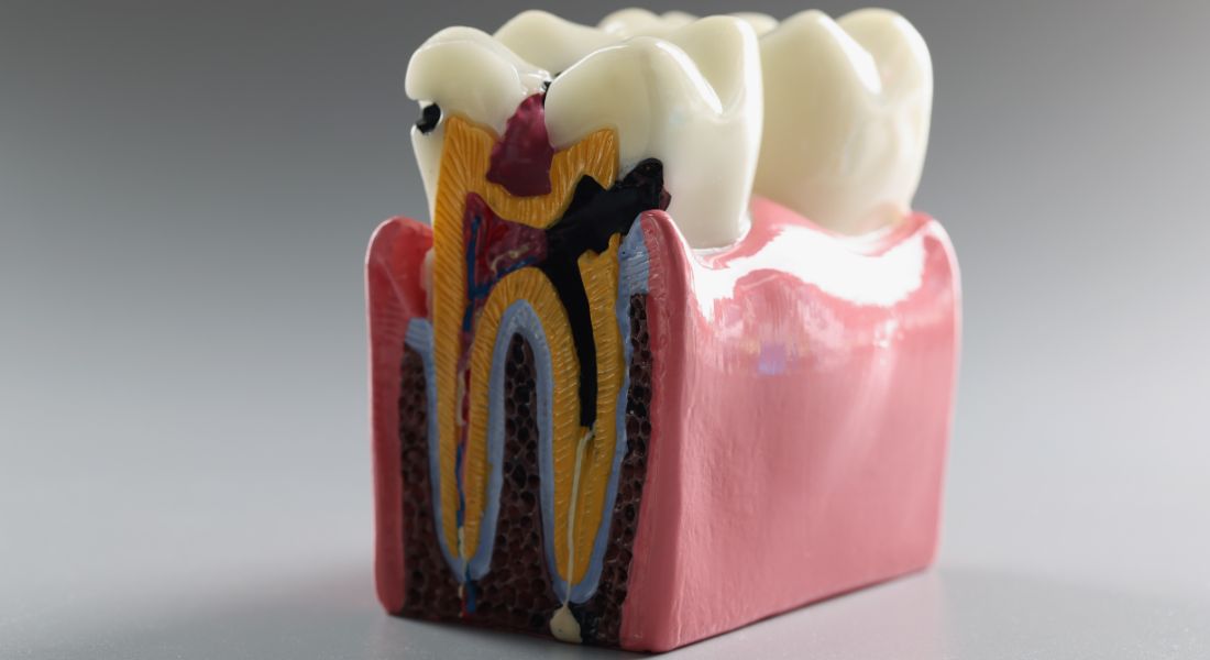 Caries dental -Qué hacer si se cae un empaste dental - Centro Odontológico Del Corte - Dentista Oviedo