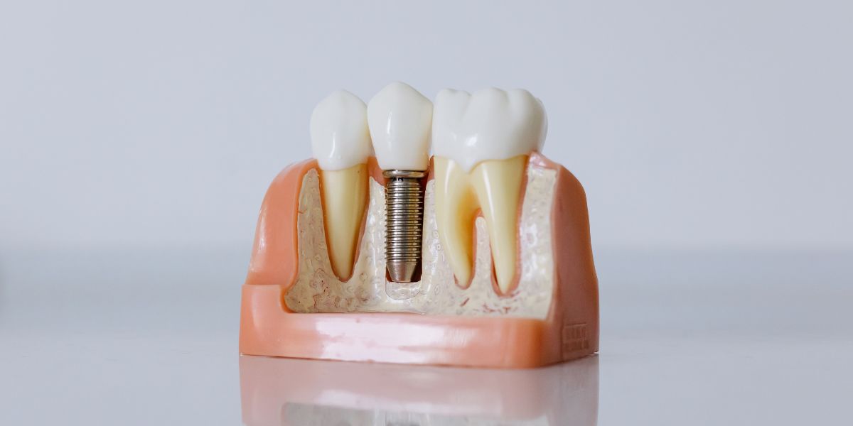 Infografía de como se ven los implantes dentales desde dentro. Implantes dentales en Oviedo